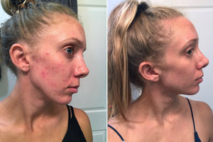 Acne, Fungal Acne, or Dermatitis? How I Cured the Worst Skin of my Life